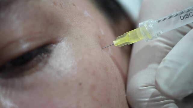 Close up of Asian woman receiving anti-wrinkle injection for crow's feet at eye corner.  Aesthetic treatment for Asian skin, close up of cosmetic injection to remove laugh lines around eyes. 
