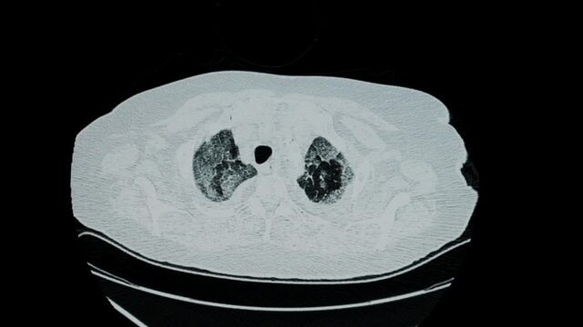 CAT Scan of elderly woman with acute pulmonary edema and lower respiratory infection and bilateral pleural effusion