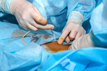 Surgical procedure taking place in a sterile environment with medical professionals engaged