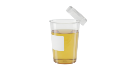Transparent Urine Sample Cup with Golden Fluid Open Lid and White Label on Clean White Background for Medical Diagnostic Analysis and Healthcare