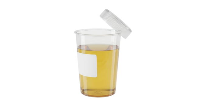 Transparent Urine Sample Cup with Golden Fluid Open Lid and White Label on Clean White Background for Medical Diagnostic Analysis and Healthcare