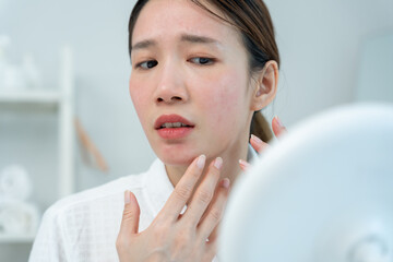 Young woman asian are worried about faces Dermatology and allergic to steroids in cosmetics....