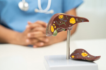 Cirrhosis, Liver cancer, fatty liver, Asian doctor with liver human anatomy model in World...