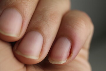 Clean short fingernails close-up. Preparation for manicure