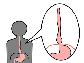 食道裂孔ヘルニア　滑脱型