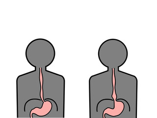正常な食道と食道裂孔ヘルニア　滑脱型