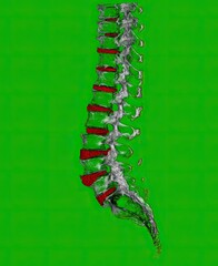 3D CT Scan Visualization of Human Lumbar Spine with Highlighted Intervertebral Discs
