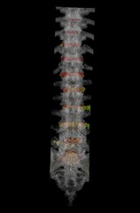 3D CT Scan Visualization of Human Lumbar Spine with Highlighted Intervertebral Discs