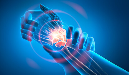 Medically accurate 3D illustration of a painful sciatic nerve cause by injury or irritation 