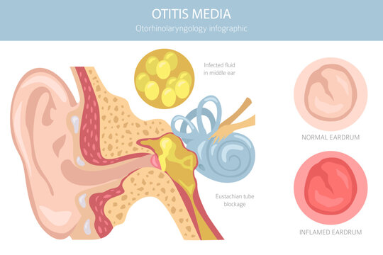 Otitis media. Infection in the middle ear. Otological disorders infographic. Vector illustration