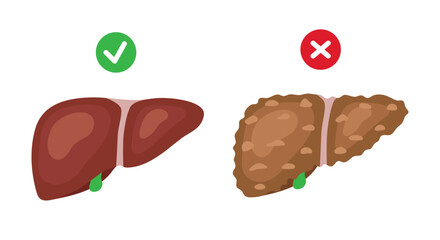 Healthy liver and liver cirrhosis. Vector illustration isolated on white background.