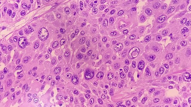 Photographic footage showing Metastatic squamous cell carcinoma of a lymph node, a type of skin cancer.