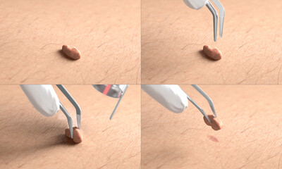 Skin surface with papilloma laser removal treatment process macro