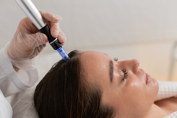 Alopecia. Woman hair loss improve growth treatment regeneration, dermapen microneedling, vitamin...