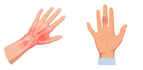 Obraz premium Hand showing arthritis symptoms with swelling and detail illustration, transparent background, isolated, vector, set 