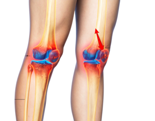 Side View of Bent Knee Showing Pain Points and Pressure Arrows, Joint Inflammation Illustration, Isolated PNG