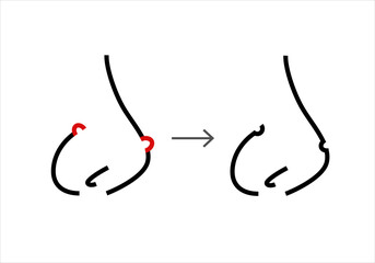 Linear chart of skin acne on nose , scars origin.