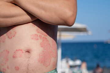 A man shows psoriasis patches on his abdomen while enjoying a sunny day at the beach with people in...