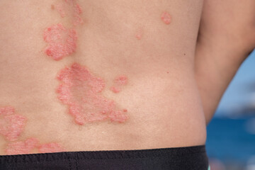 Psoriasis patches are visible on the back of a person enjoying a sunny day outdoors. The skin...