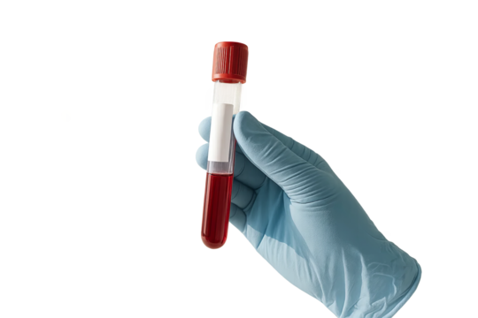 Gloved hand holding labeled blood vial in daylight, blood test with vial and transparent background