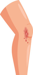 Vector illustration of a bent human leg with a fresh bleeding scrape on the knee.
