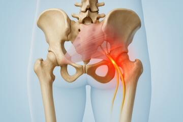 Posterior pelvic anatomy with red glow under piriformis muscle showing sciatic nerve entrapment, ideal for illustrating piriformis syndrome and related sciatic irritation in clinical visuals.