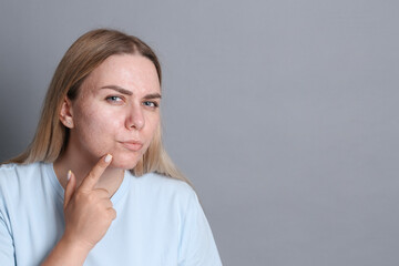Woman with acne problem on grey background, space for text