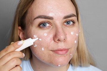 Woman applying cream onto face on grey background. Acne treatment