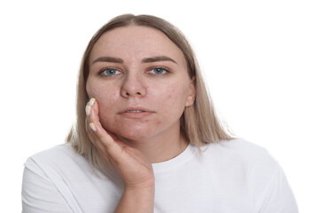 Woman with acne problem on white background