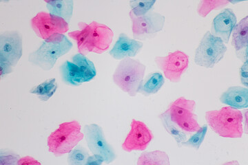 View in microscopic of normal human cervix cells.Squamous epithelial cells from pap smear cervixl and vaginal woman.Cervical cancer screening test.