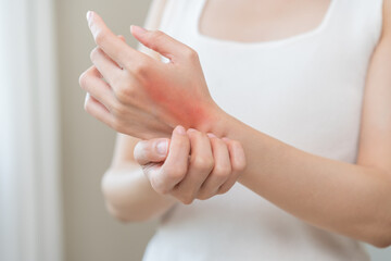 Dermatology asian young woman allergy, allergic reaction from atopic, insect bite, scratching itchy back of hand, red spot or rash of skin. Healthcare treatment of beauty. Isolated on white background