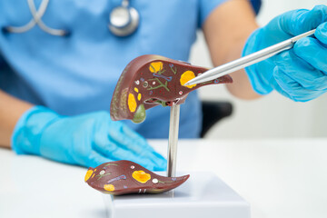 Cirrhosis, Liver cancer, fatty liver, Asian doctor with liver human anatomy model in World...