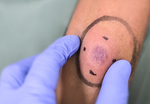 Mantoux vaccination, Closeup view photography of patient arm with red spot reaction to conducting Mantoux test. Positive tuberculosis patient.