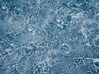 Sputum analysis under microscope showing numerous septate branching hyphae with acute angles,...