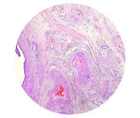 Hematosalpinx, is a condition where blood accumulates within the fallopian tubes, often associated with ectopic pregnancy, but can also be linked to endometriosis, PID or pelvic trauma