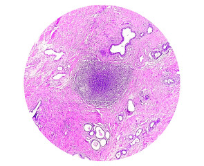 Photomicrograph,  prostatitis (CP), a common condition that causes inflammation of the prostate...