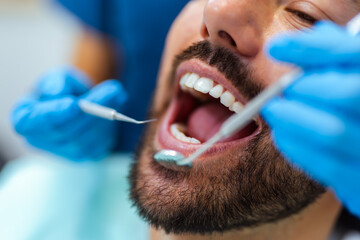 Close-Up of Man with Open Mouth at Dental Exam