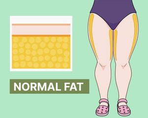 A woman's lower body. Normal fat. A healthy woman's body. Medical illustration. Vector illustration. 