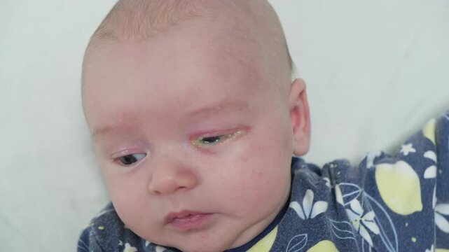 Baby eyes with eye mucus in selective focus. Disease tear ducts tons of newborns close up. Nasolacrimal duct obstruction in baby it is a blockage of the lacrimal drainage system. 