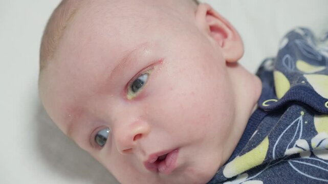 Baby eyes with eye mucus in selective focus. Disease tear ducts tons of newborns close up. Nasolacrimal duct obstruction in baby it is a blockage of the lacrimal drainage system. 