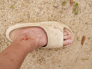 Naked feet in white summer plastic slippers. There is multiple bleeding wounds caused by mosquito...