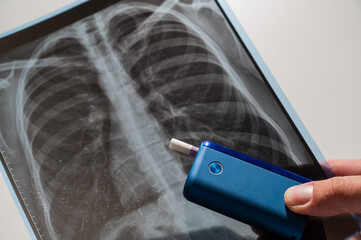 Electronic cigarette and lung x-ray. Tobacco heating system. 