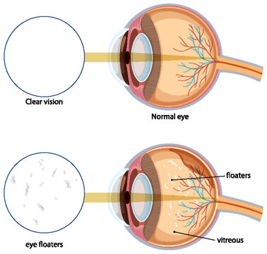 Comparison of Normal Eye and Eye Floaters Illustration