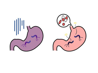 ピロリ菌に感染した胃と除菌している胃