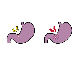 胃潰瘍と胃アニサキス症