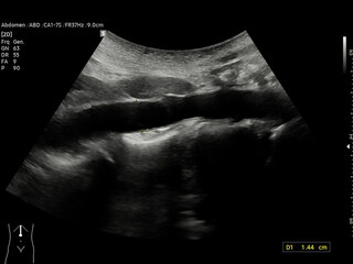 A normal ultrasound of the upper abdomen, showing healthy organs with no abnormalities. Clear imaging of the liver, pancreas, and surrounding structures.