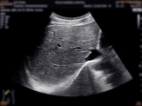 A normal ultrasound of the upper abdomen, showing healthy organs with no abnormalities. Clear imaging of the liver, pancreas, and surrounding structures.