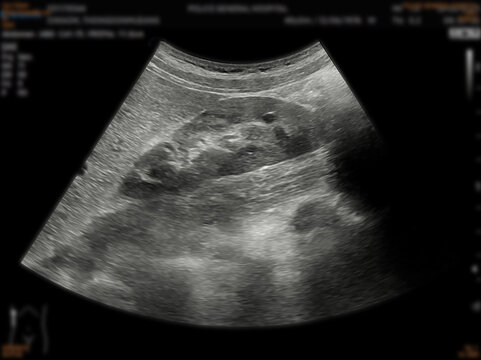 A normal ultrasound of the upper abdomen, showing healthy organs with no abnormalities. Clear imaging of the liver, pancreas, and surrounding structures.