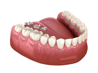 Amalgam filling restoration. 3D illustration