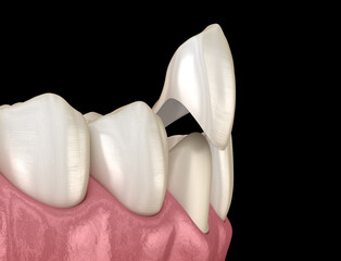 Dental veneer placement on canine teeth. 3D illustration